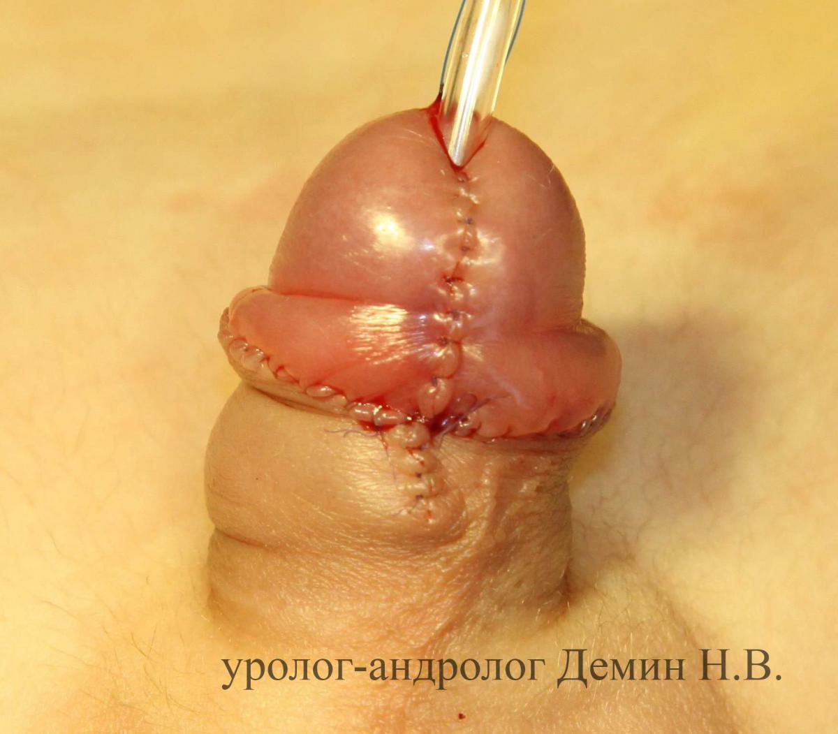 Венечная гипоспадия, фото после операции